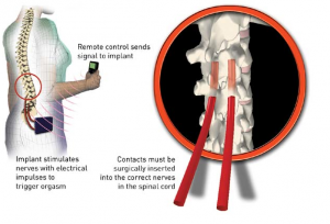 Impianto orgasmo elettrico
