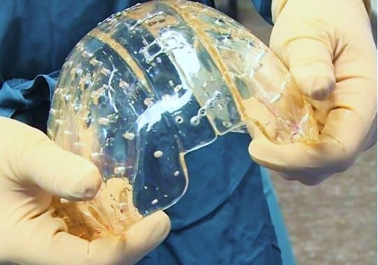 Cranio in 3D: in Cina  primo intervento  su bimba di 3 anni